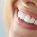 Cosmetic Dentistry: What You Need To Know About Porcelain Veneers In Beverly Hills, CA