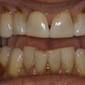 Can cosmetic dentistry fix receding gums?