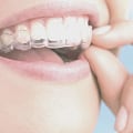 What You Need To Know Before Getting Invisalign In Austin For Your Cosmetic Dentistry Needs