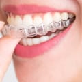 Straightening Your Teeth With Braces: How Cosmetic Dentistry In Austin Can Help