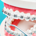 Are dental braces considered cosmetic?