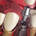 Cosmetic Dentistry In Spring Branch: A Comprehensive Guide To Dental Implants