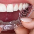 Perfecting Your Smile In North Las Vegas: Orthodontics As The Finishing Touch After Cosmetic Dentistry