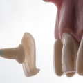 How To Decide If Porcelain Veneers Are Right For You: A Guide To Cosmetic Dentistry In Austin