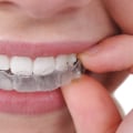 Everything You Need To Know About Invisalign In Georgetown As Part Of Cosmetic Dentistry