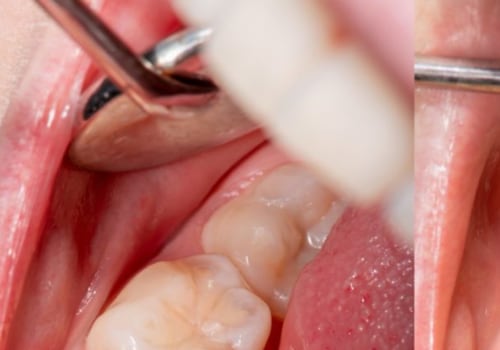 Do cosmetic dentists do fillings?