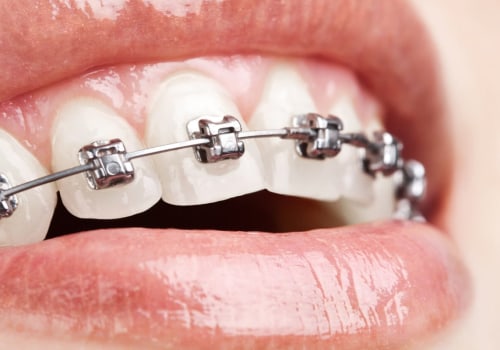 Are cosmetic braces safe?