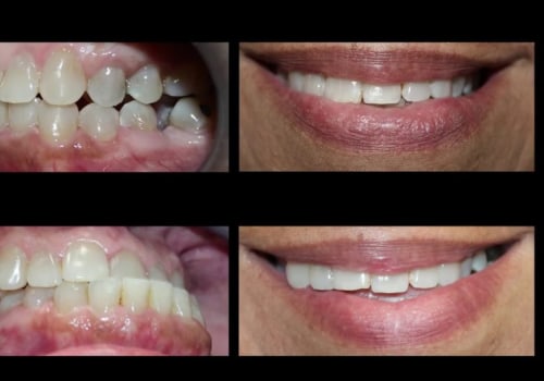 Cosmetic Dentistry: Invisalign In San Antonio For Teeth Straightening Without Braces