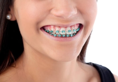 Do braces count as cosmetic dentistry?