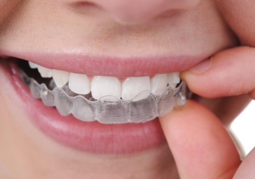 Everything You Need To Know About Invisalign In Georgetown As Part Of Cosmetic Dentistry